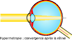 hypermetropie